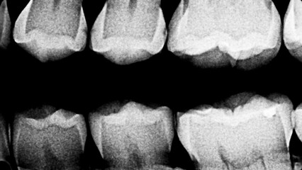Human teeth x-ray or ct scan. Human black white body parts of jaw, teeth. Scary Halloween background.