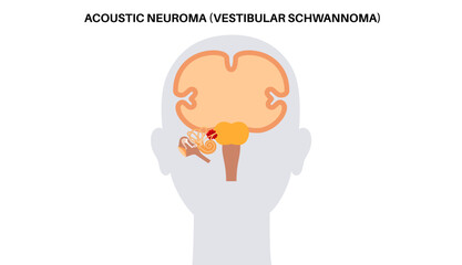 Acoustic neuroma poster