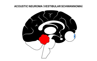Acoustic neuroma poster