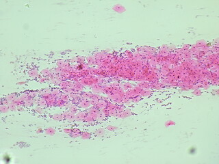 pap smear, NILM (class II non specific chronic inflammation) under a microscope view for education...