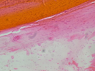Human cervical squamous epithelial cells under microscope view. Pap smear test a procedure to test for cervical cancer in women.