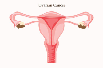 Ovarian cancer diagram showing tumor growth in the ovaries. Eps 10