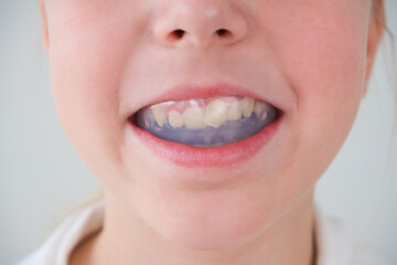Dental simulator for teeth alignment . The child has mouth guards on his teeth.
