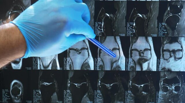 Doctor examines an MRI scan revealing a problem in a patient's knee joint. The MRI image shows signs of osteoarthritis in the knee