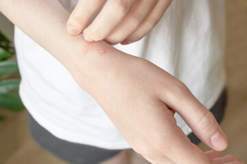 Fototapeta premium Close-up of skin with allergic skin disease with redness and itching