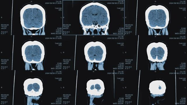 Magnetic resonance images of the head, MRI of the brain,front viev of a patient with multiple vascular infarctions, 3x3 grid and 1 image, monochrome animation Seamless Loop