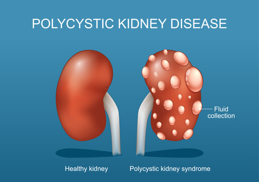 Polycystic kidney disease