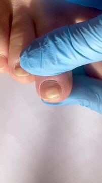 toenail with fungal infection or damage, close-up of nail health problems, nail fungus, doctor examining diseased toenails