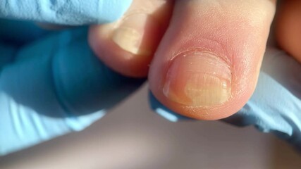 nail fungus, toenail with fungal infection or damage, doctor in blue medical glove examines diseased toenails