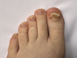 Onychomycosis. Dangerous fungal infection of human toenails on a white background at the doctor....
