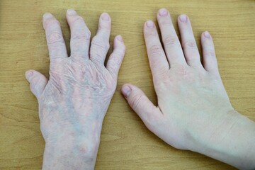 Comparison of Healthy Hand and Arthritic Hand
