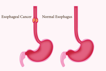 Healthcare infographic of esophageal cancer and normal esophagus