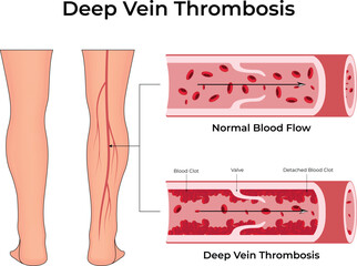 Deep Vein Thrombosis Understanding Blood Clots in the Legs Vector Illustration