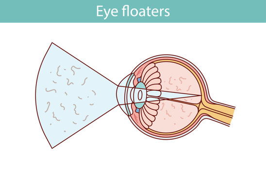 Eye floaters. cartoon style vector illustration
