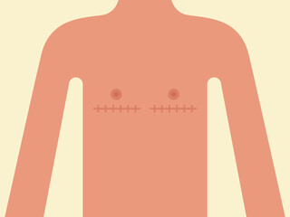 Male transgender body with stitch marks