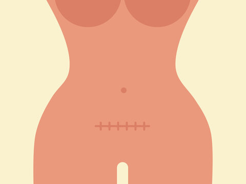 Cartoon female body with scar