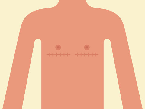 Male transgender body with stitch marks