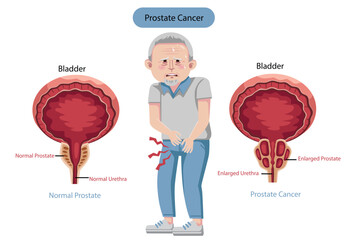 Male Reproductive System Anatomy and Normal Prostate and Prostate Cancer Inflammation