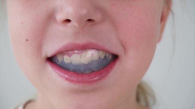 Dental simulator for teeth alignment . The child has mouth guards on his teeth.