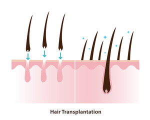 Before and after hair transplantation illustration. Permanent hair restoration, hair transplant surgery is procedure that moves hair follicles from a donor area to bald or thinning area of the scalp.