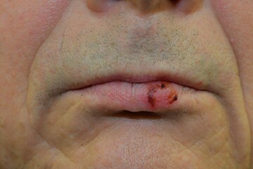Oral herpes on the lip. Cold sore on the mouth. Fever blister on lips. The concept of vitamins and...