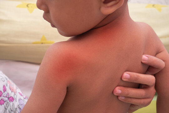 Red rash on baby skin at the back, Roseola infantum, Exanthema subitum, rose rash of infants, baby measles. 