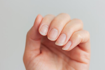 A close-up photo of a woman’s fingers with damaged layered nails. White background. Lack of...