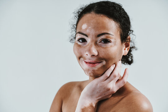 Beautiful woman with vitiligo skin posing in studio. Concept about body positivity and self acceptance