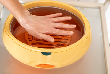 Paraffin therapy. Woman dipping her hand into a paraffin wax bath.