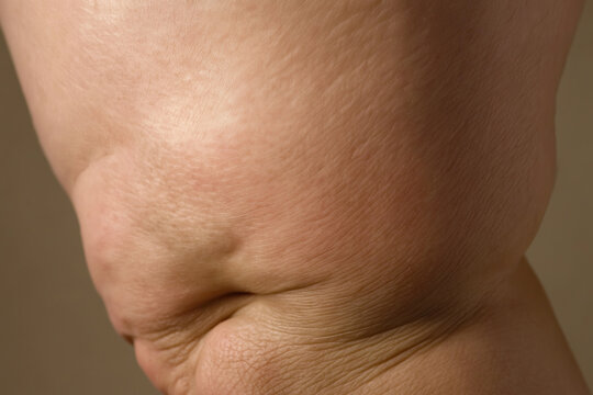 womans legs with lymph edema