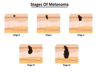 Stages of melanoma vector illustration