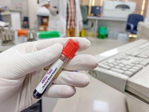 Scientist hold blood sample for Arterial blood gases test. Healthcare and medical test concept.