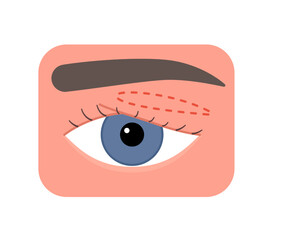 Eyelid correction with cutting line, blepharoplasty. Aesthetic plastic surgery of eye. Lift eyelid. Surgical facial rejuvenation. Vector illustration