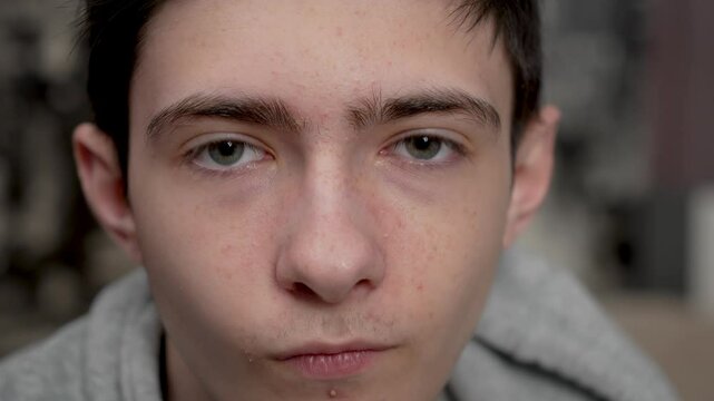 Sad teenage boy with acne portrait. Melancholy adolescent boy showing puberty acne. Downcast young man with pimples skin