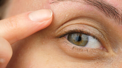 Close-up eye with milia and breakouts. Cosmetic procedures skin around eyes improve health and...