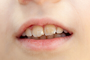 Close up of a child's smile revealing teeth affected by hypomineralization, a developmental defect...