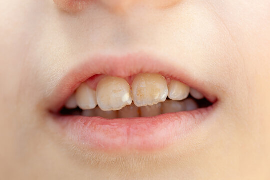 Close up of a child's smile revealing teeth affected by hypomineralization, a developmental defect impacting enamel formation, causing discoloration and increased sensitivity