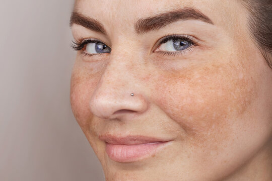 Close up caucasian woman's face with freckles or age spots. Age spots on the face, melasma