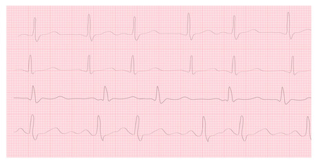 ECG Hyperkalemia. 8 Second ECG Paper. Electrocardiogram. Cardiogram. Heart beat. Heartbeat line. Electrocardiogram. Vector Stock Illustration. Isolated on white background. 