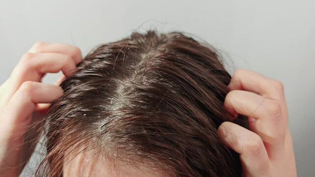 Woman scratching itchy scalp, feeling discomfort