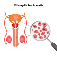 Chlamydia Trachomatis. Woman’s and man's reproductive system infections. Medical disease 