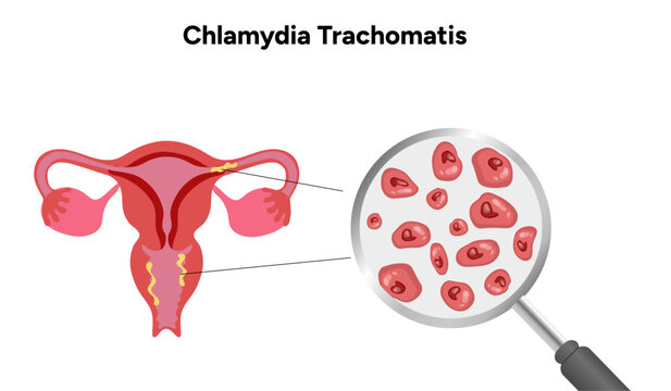 Chlamydia Trachomatis. Woman&rsquo;s and man's reproductive system infections. Medical disease 