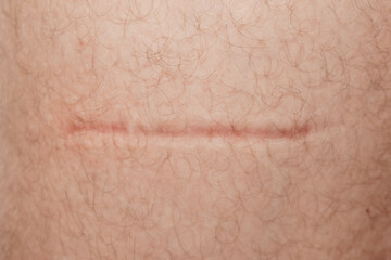 Fototapeta premium A close-up of a healed scar on the body, highlighting natural skin regeneration.