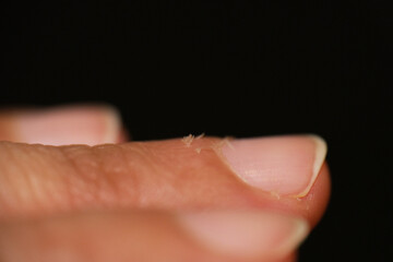 Paronychia is nail inflammation that may result from trauma, irritation or infection
