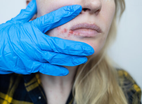 Herpes on the lips of women. A dermatologist examines and treats with ointment fever blisters of the herpes simplex virus