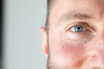 Close-up of man showing signs of rosacea skin condition