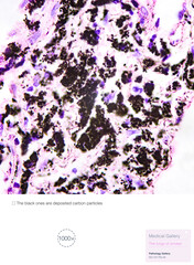 Pathological photos of smokers' lungs show that the black substance is deposited carbon powder, which can easily cause interstitial lung disease and COPD. Magnify 1000x.
