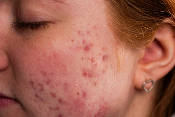 Skin texture background. Closeup acne pimple. Treatment for skin. Problem skincare. Pimples, acne, pores, scars. Natural skin. Skin care concept. Acne treatment. Pimples on face. Acne and pimple.