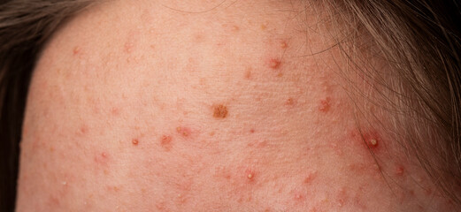 Skin acne background. Closeup acne pimple. Treatment for acne skin. Problem skincare. Pimples,...