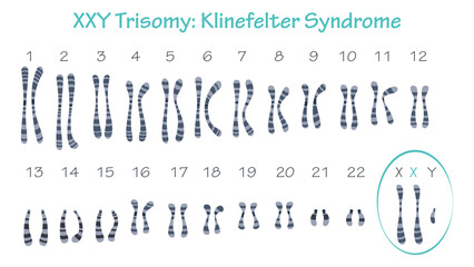 Klinefelter Syndrome XXY trisomy karyotype graphic